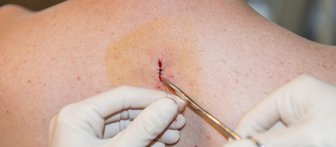 cirurgia câncer de pele