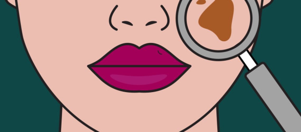 tipos-de-manchas-de-pele-tomozina